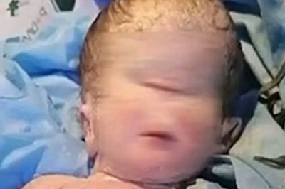 Baby With One Eye Is Born in Iraq; Pictures Go Viral